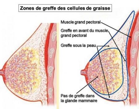 Lipofilling mammaire Tunisie 