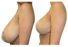 reduction seins avant apres